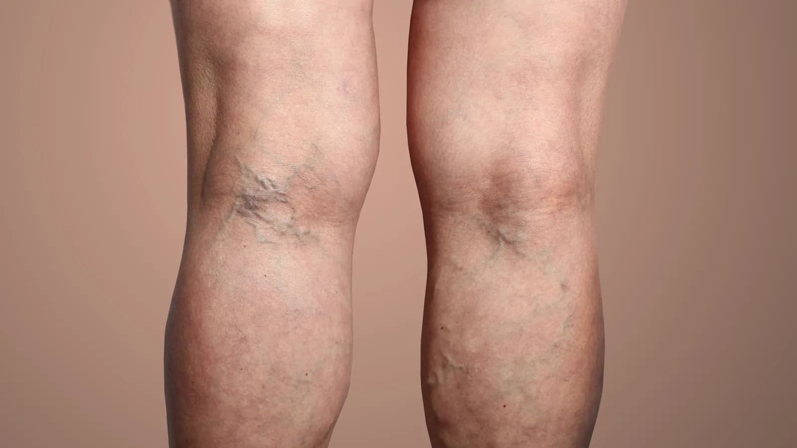 Backs of an adult’s lower legs showing enlarged veins on the calves.