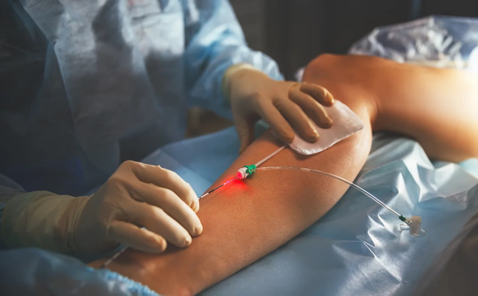 Minimally invasive catheter-based venous angioplasty being performed on a patient's leg in the office.